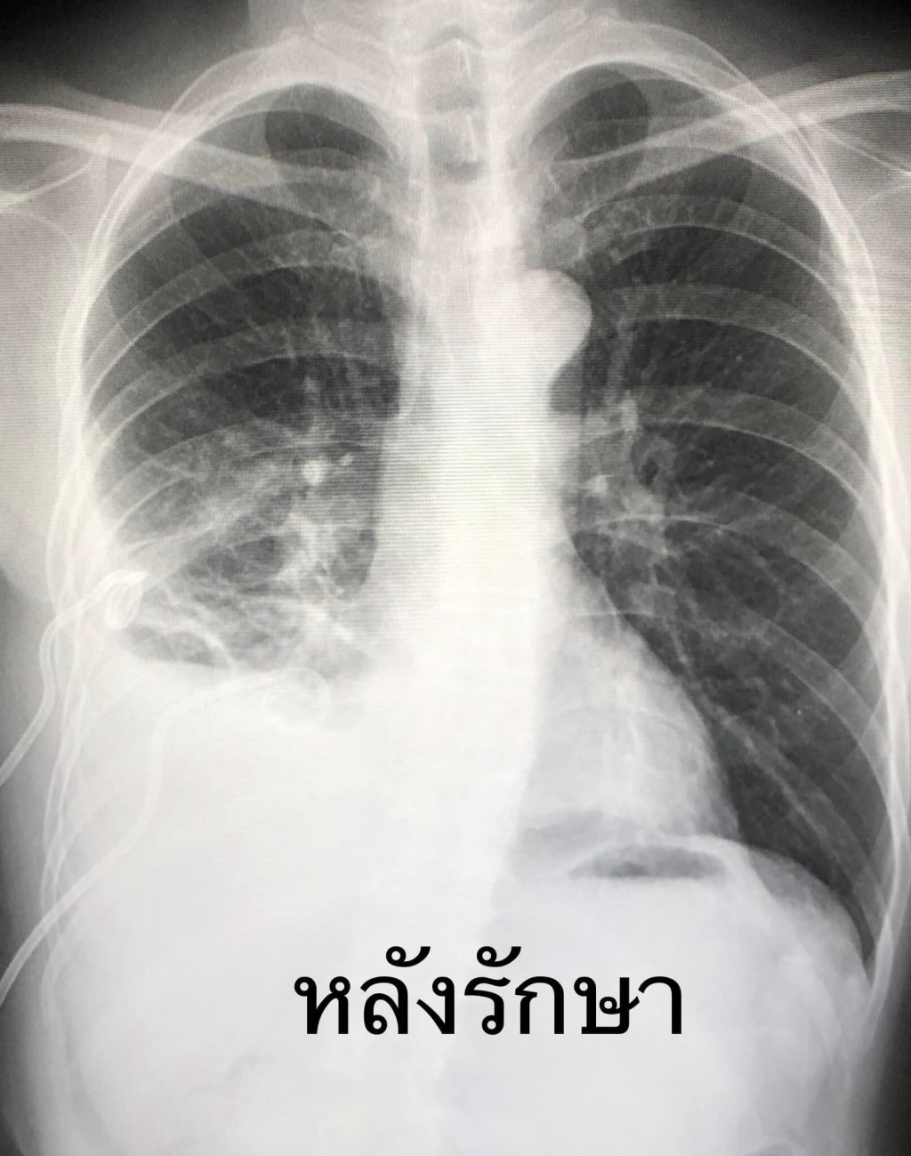 X光片顯示，患者右側肋膜腔有大量液體和凝塊。（圖片來源：Facebook@หมอมนูญ ลีเชวงวงศ์ FC）